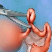 چهار هشدار در مورد وازکتومی